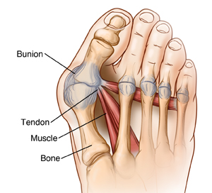 Foot and toes showing big toe bent at base, forming bunion.