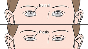 Closeup of eyes showing normal eyelids. Closeup of eyes showing ptosis.