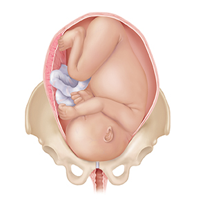 Front view of full-term fetus in uterus in pelvic bones, with head down. Head and body are too large for birth canal.