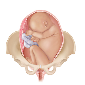 Front view of full-term fetus in uterus in pelvic bones with head up, showing breech position.