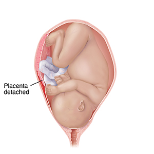 Front view of full-term fetus in uterus in pelvic bones with head up. Placenta is detached from wall of uterus showing placental abruption.