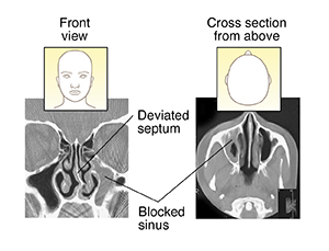 CT scan of deviated septum and blocked sinus (front view). CT scan of blocked sinus (cross section from above).