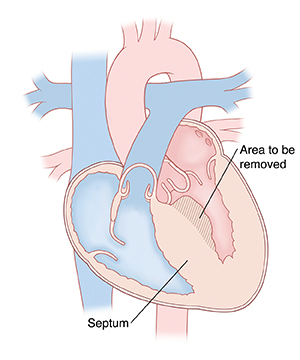 Four-chamber view of heart showing thickened septum toward left ventricle. Shaded area shows part of septum to be removed in septal myectomy.