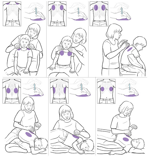 How to do chest percussions to help your child drain mucus from lungs.