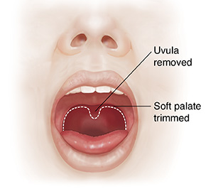 Front view of face showing nose and open mouth. Dotted line shows soft palate tissues to be removed.