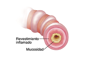 Corte transversal de los bronquiolos donde puede verse la vía respiratoria casi totalmente bloqueada por mucosidad, inflamación y músculos contraídos.